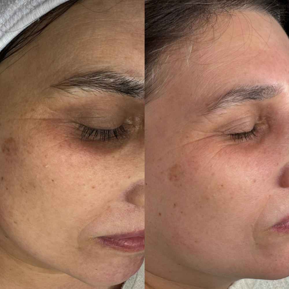 Terapia na przebarwienia Aquashine BR, mezoterapia igłowa, skin reset